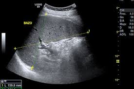 ultrasonido de una ESPLENOMEGALIA